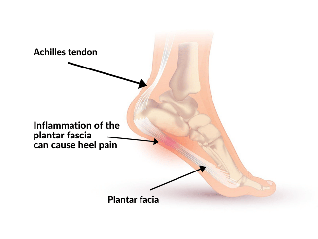 Plantar Fasciitis is a common foot complaint treated by Osteopaths