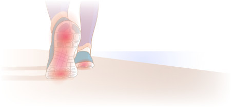 What Is Plantar Fasciitis?