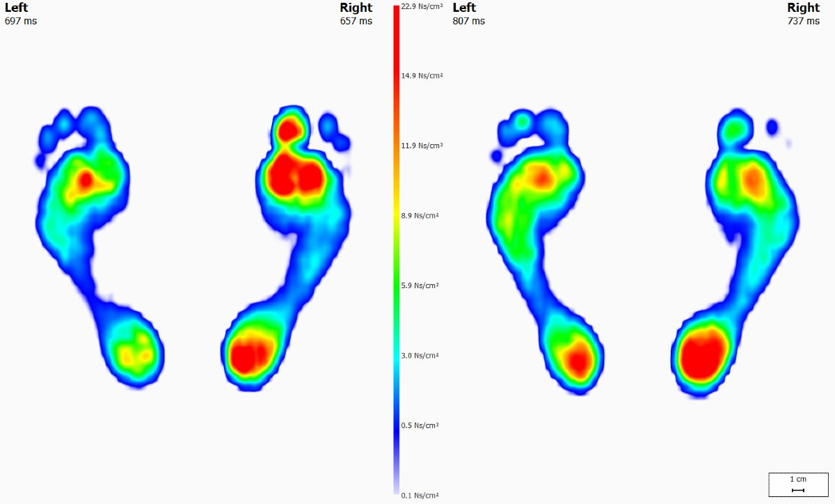 Footscan gait analysis scans